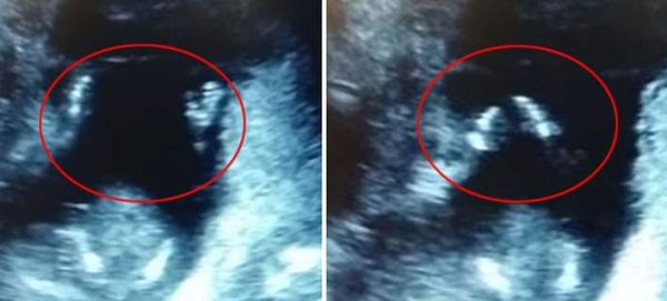 Εμβρυο χτυπά παλαμάκια στην κοιλιά της μητέρας του όταν εκείνη του τραγουδά [βίντεο]